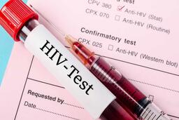 HIV/AIDS: TRIỆU CHỨNG, ĐIỀU TRỊ VÀ CÁCH PHÒNG BỆNH